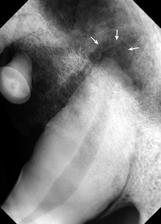 Tooth Fracture | Clinician's Brief
