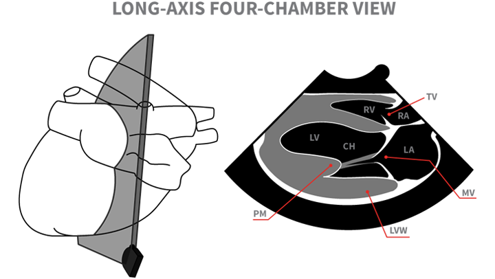 Cardiac Ultrasound Video Right Parasternal Long Axis Chamber View | My ...