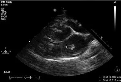Echocardiogram of a cat with marks detailing an outline of a left atrial thrombus.