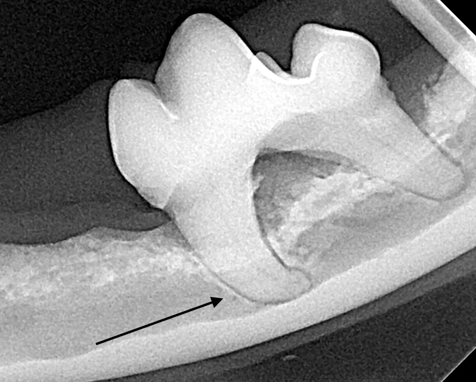 Four dental radiographs showing different root anomalies that can contribute to root fracture during extraction. 