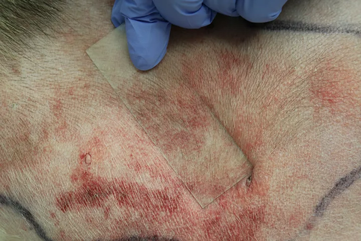 Gloved hand pressing glass slide against erythematous dog skin.