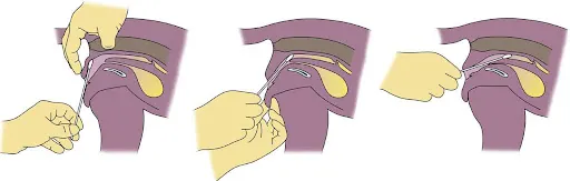 3-part diagram illustrating proper technique for inserting cotton swab to collect vaginal cells for cytology.