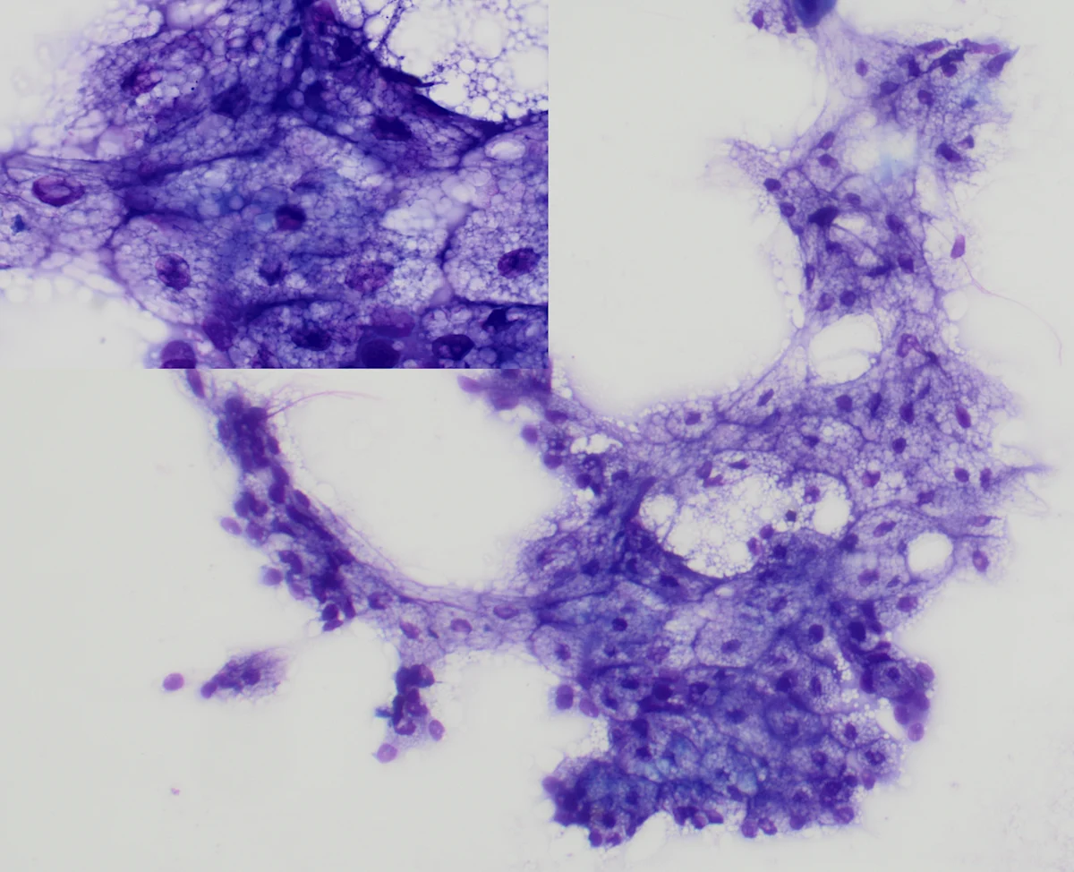 Clusters of variably sized rounded cells with vacuolated light-purple cytoplasm and dark-purple nuclei and borders.