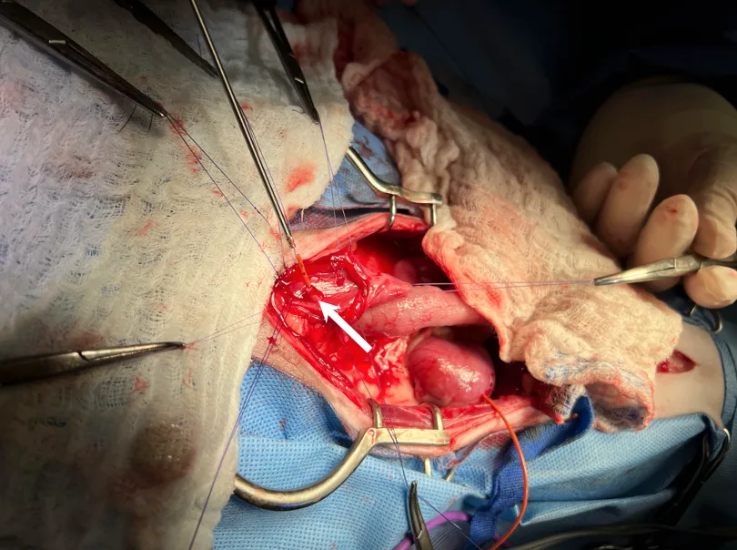 The perioperative photo shows a red rubber catheter placed from the urinary bladder through an extramural ectopic ureter.