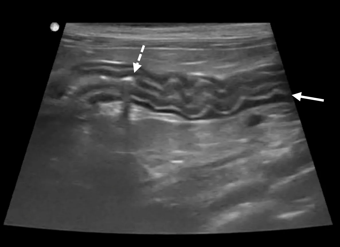 Ultrasound that shows muscularis layer thickening in a cat. 