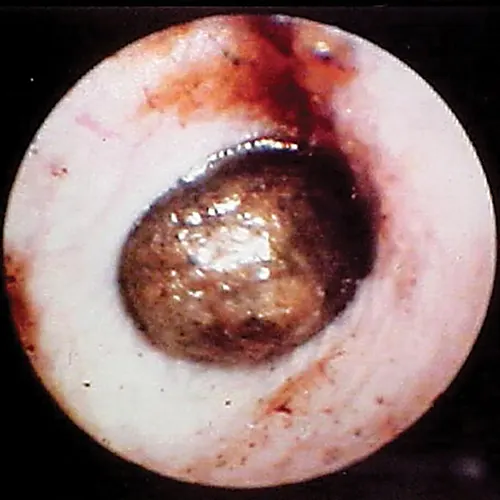 Globoid brown-to-black mass occluding internal ear canal.