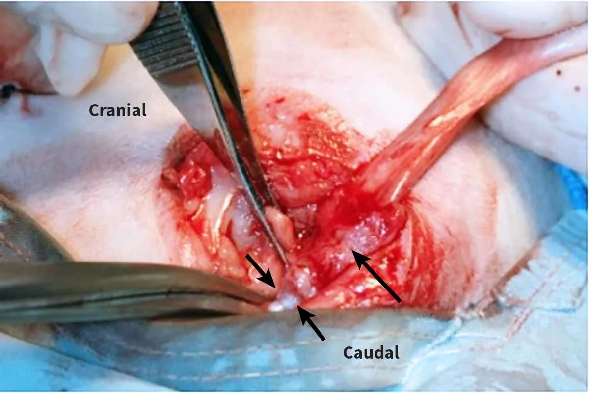Intraoperative photo of a surgeon transecting the ischiocavernosus muscle.