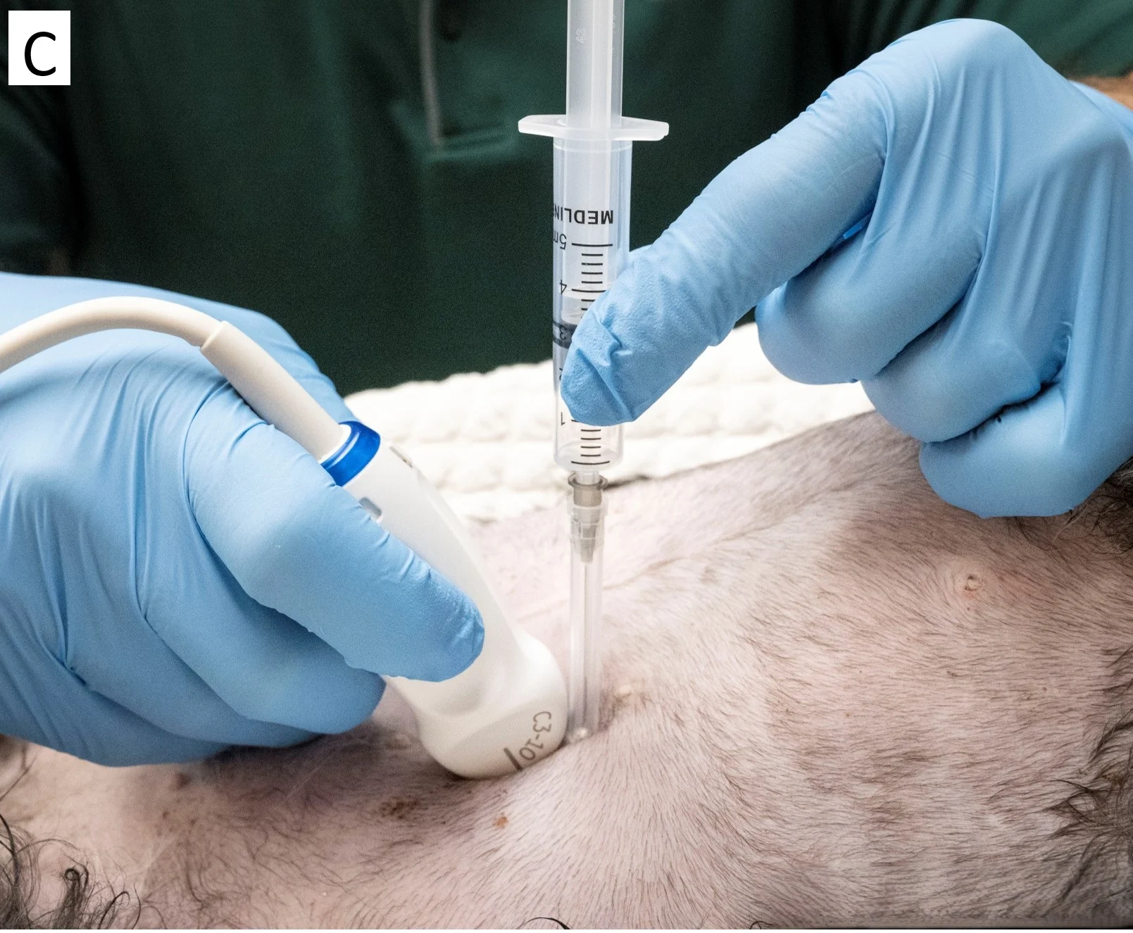 Gloved hands holding ultrasound transducer and syringe showing various angles of the syringe relative to abdomen.