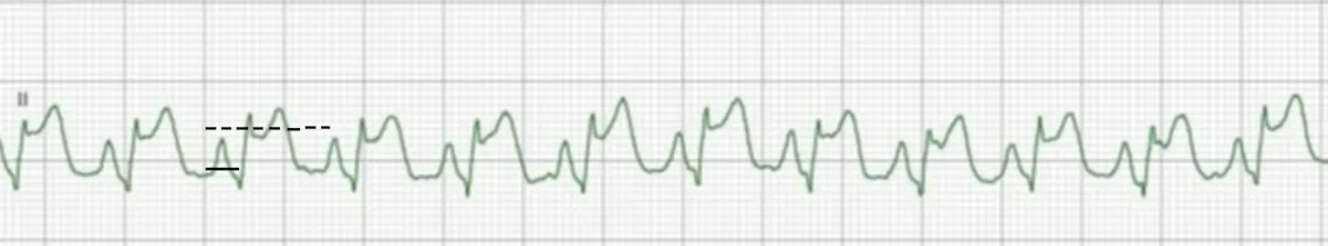 ECG tracing with lines showing an ST segment higher than the baseline.