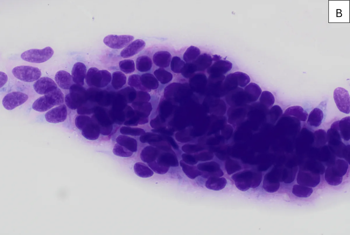 Multiple clusters of round-to-oval dark purple–staining cells.