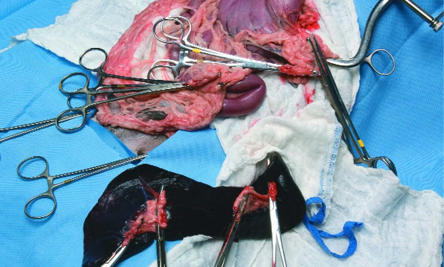 Clamped vessels have been incised and the spleen has been removed from the surgical site.