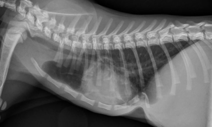 pectus excavatum x ray