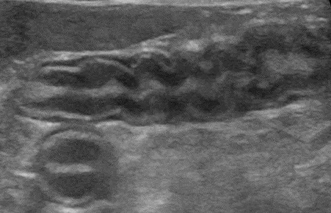 Ultrasound image of jejunum showing signs of inflammatory bowel disease.
