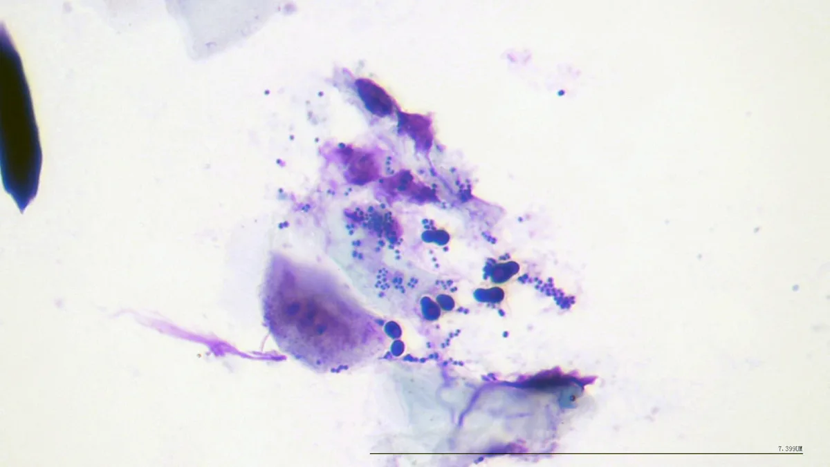 Cytology showing cornified cells, budding yeast bodies, and numerous cocci bacteria.
