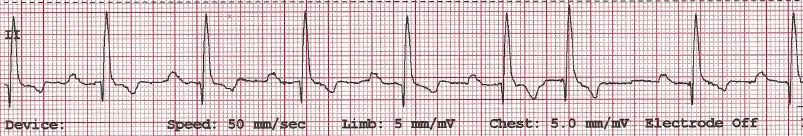 Two ECG tracings demonstrating narrow and wide premature QRS complexes.