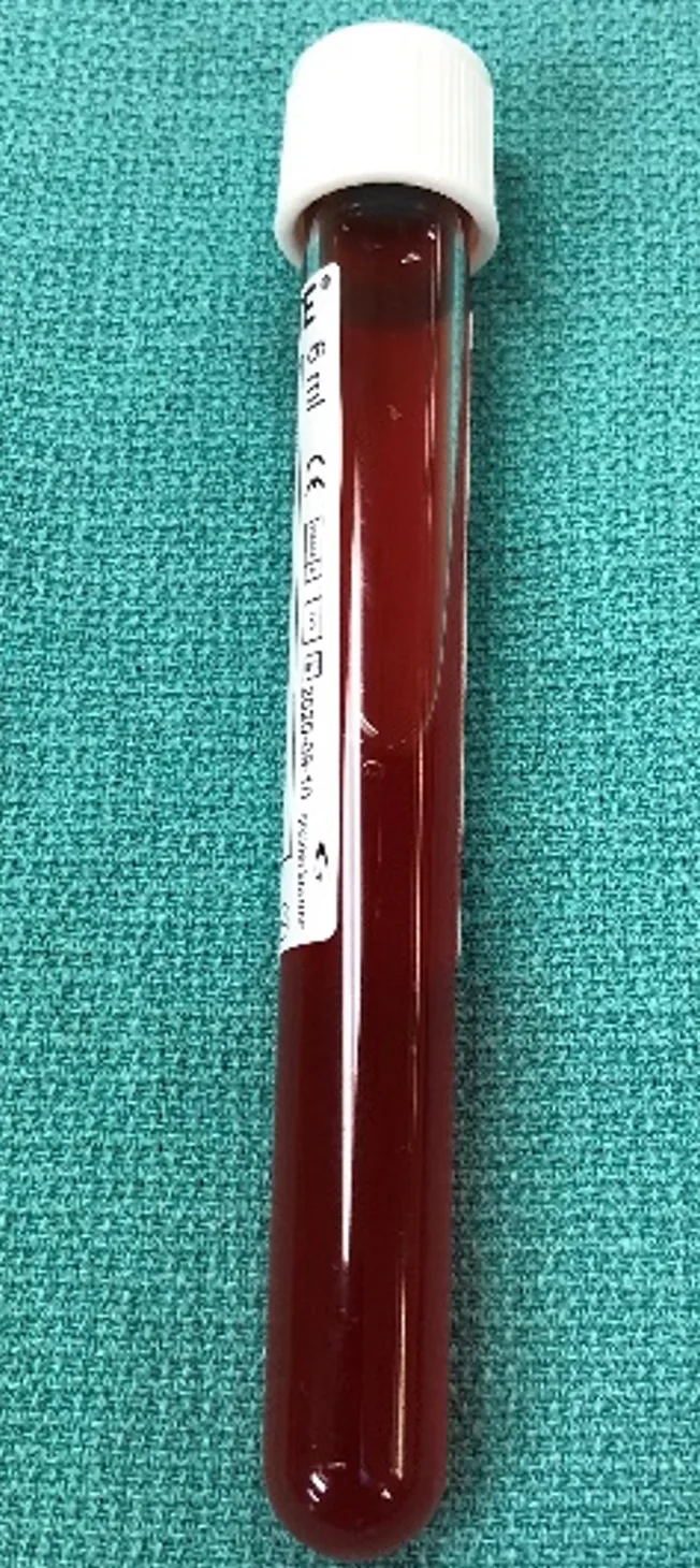 Glass vial with blood-tinged fluid lying on surgical drape.