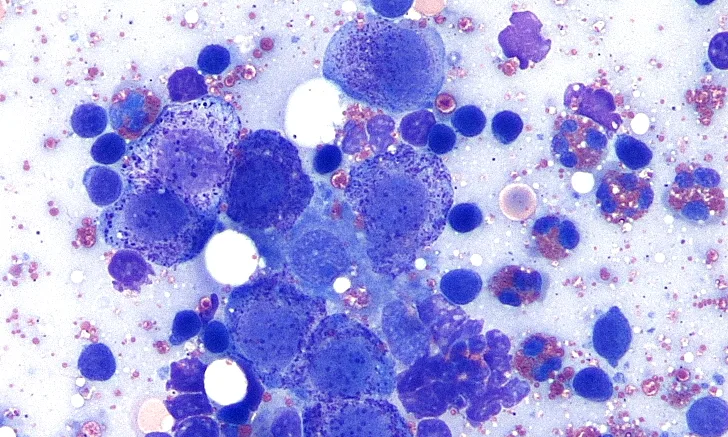 Aspirate of metastatic mast cell tumor obtained from a lymph node.