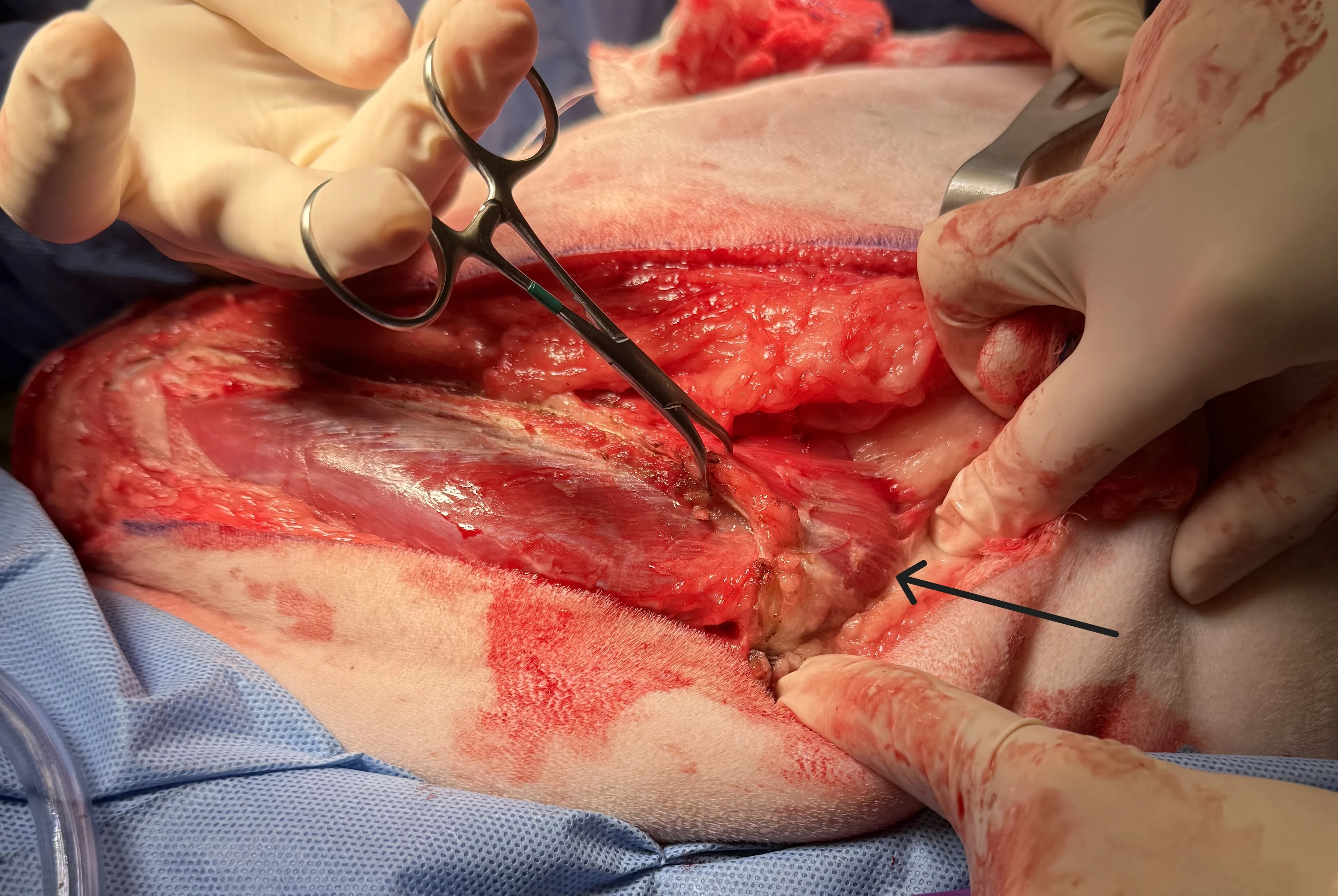 Gloved hands holding towel clamp attached to scapular spine with arrow pointing to attached muscle.