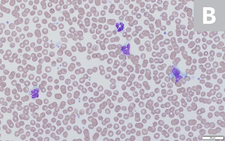 Side-by-side images of blood smears illustrating differences seen in fresh blood versus refrigerated blood.