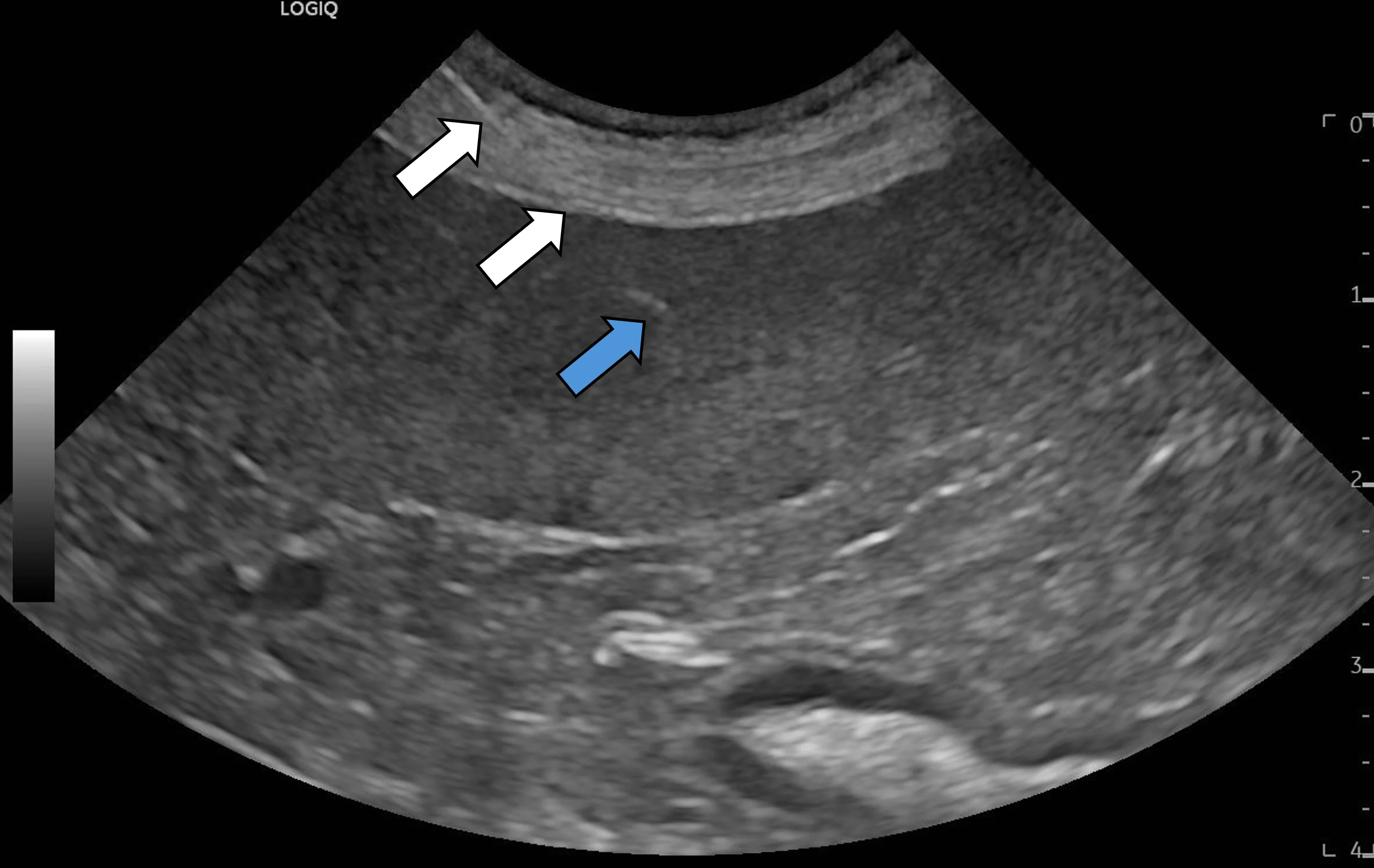 An ultrasound image with arrows pointing to the needle entering the abdomen.
