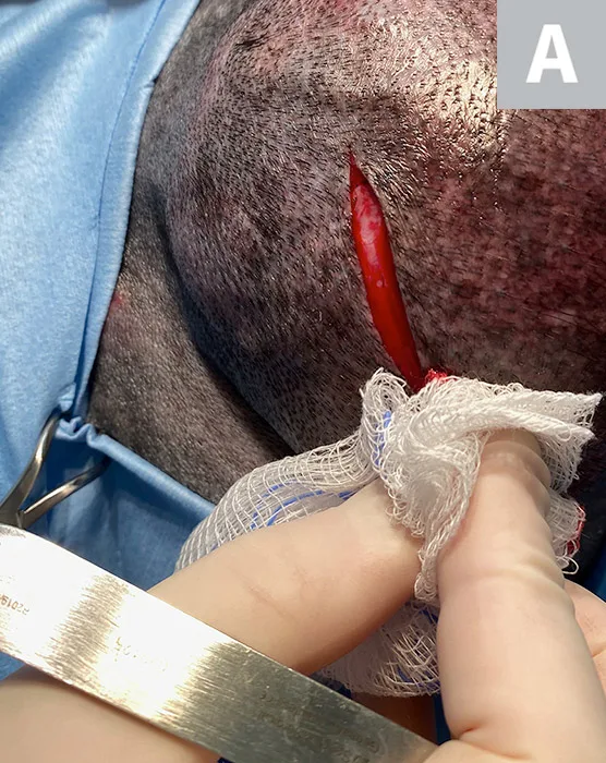 Gloved hands holding gauze over skin incision before and after incising through SC tissue.