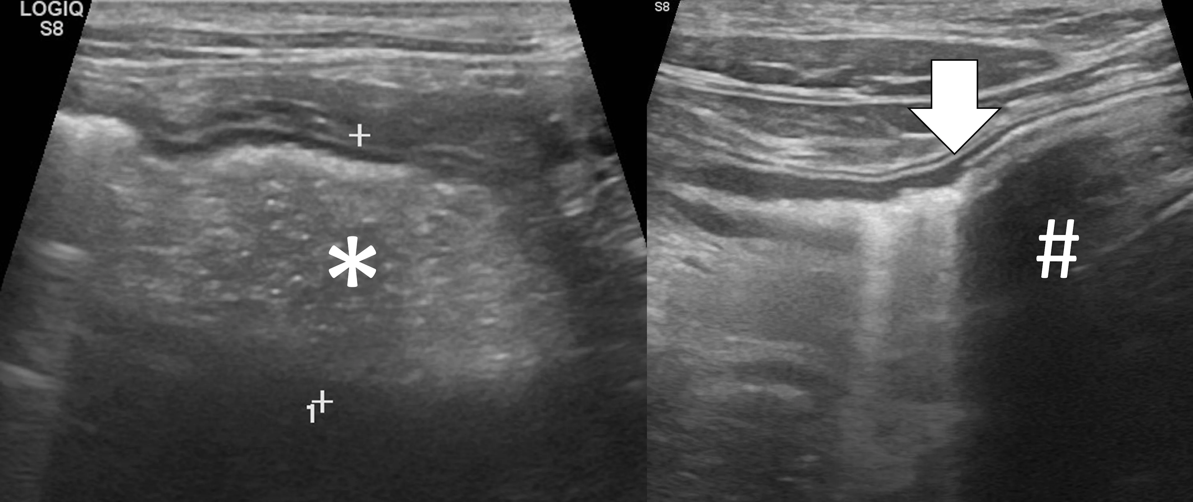 Side-by-side abdominal ultrasound images demonstrating changes associated with a pecan foreign body.
