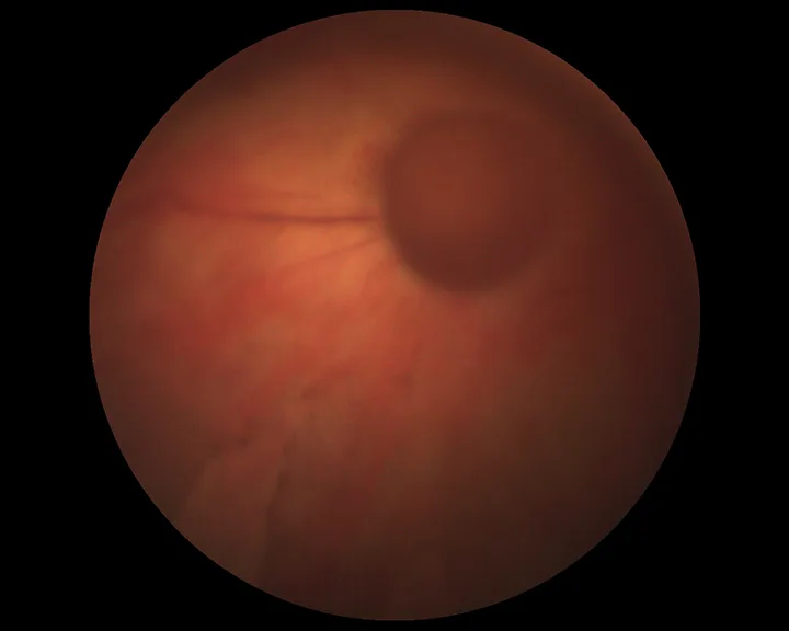 The patient’s left fundus.  