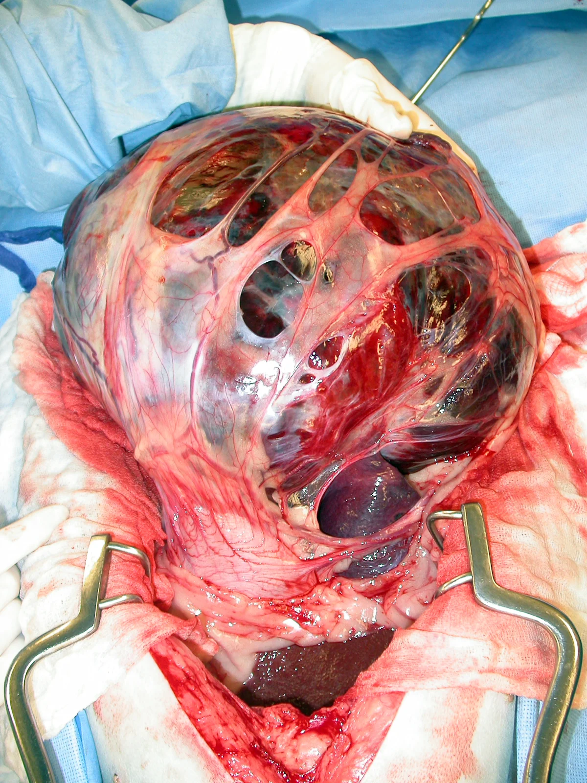 An abnormal, exteriorized spleen covered by omentum.