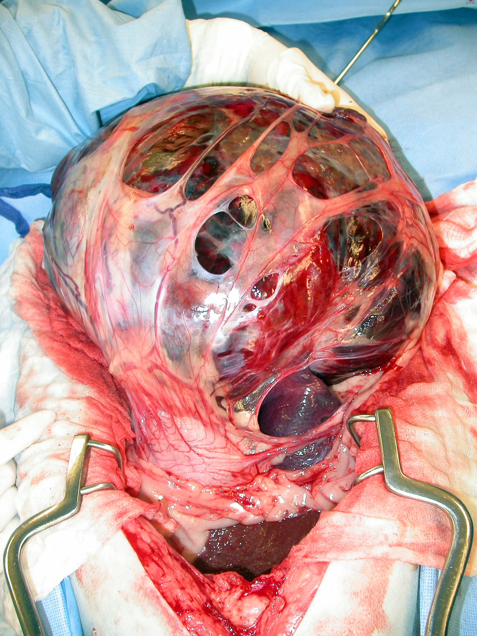 An abnormal, exteriorized spleen covered by omentum.