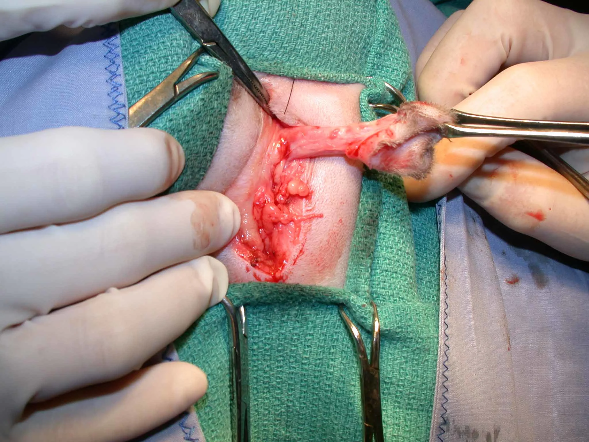 A: Intraoperative photograph of a surgeon using Metzenbaum scissors to dissect subcutaneous tissue from the penile body.  B: Intraoperative photograph of a surgeon using gauze to strip subcutaneous tissue from the penile body.