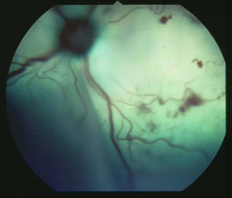 Pale hazy retina with darker regions and thick prominent blood vessels.