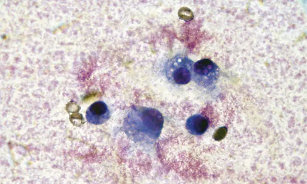 Cytology of joint fluid showing predominance of mononuclear cells with vacuolar inclusions.