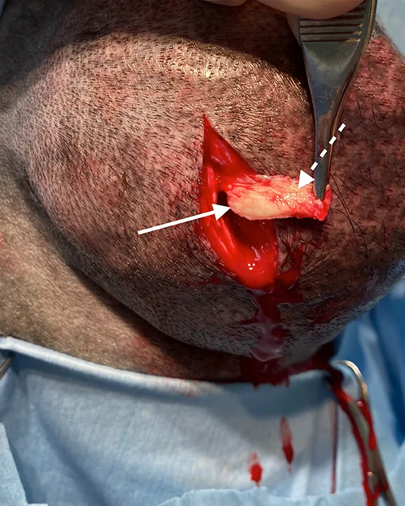 Mosquito forceps removing tumor sample from surgical site with arrows pointing to regions of the sample.