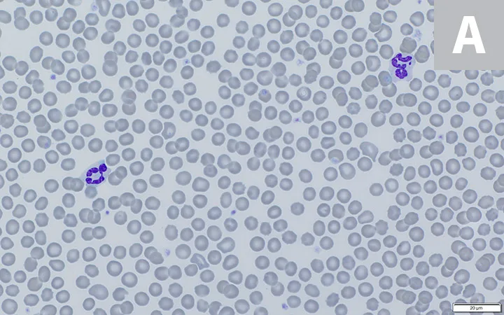 Side-by-side images of blood smears illustrating differences seen in fresh blood versus refrigerated blood.