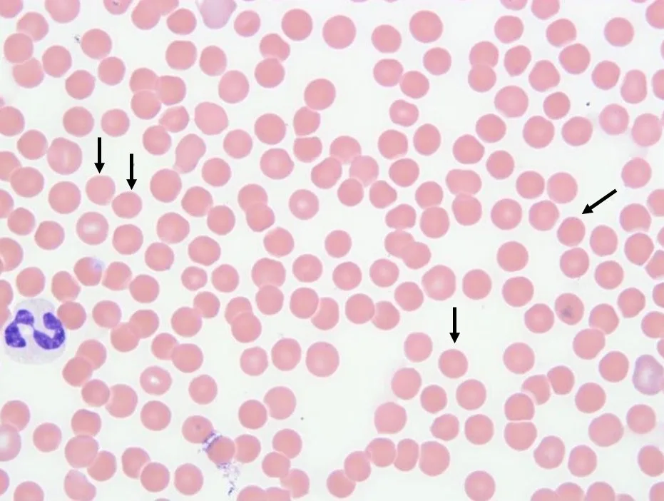 Blood smear of dog showing a single neutrophil and arrows pointing to several RBCs that lack normal central pallor.