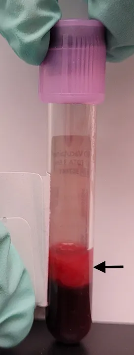 Purple-top test tube with dark colored pellet on bottom and arrow pointing to opaque pink fluid layer on top of pellet.