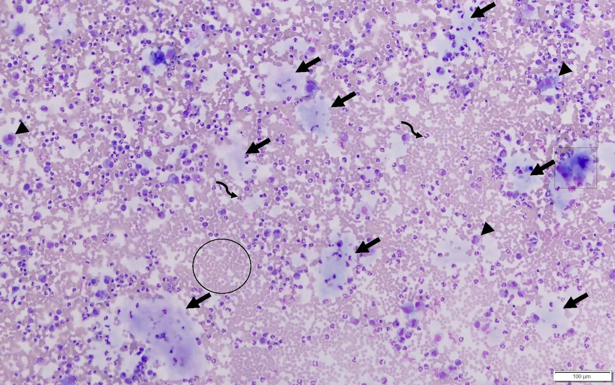 First microscope image of peritoneal fluid from the patient.