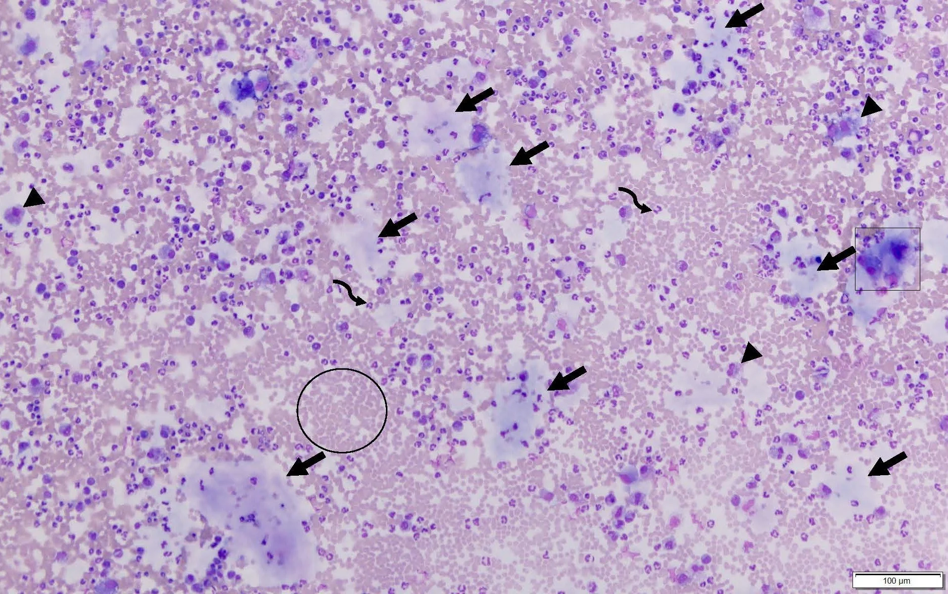 First microscope image of peritoneal fluid from the patient.