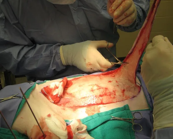 Skin being removed from a dog by a surgical team.