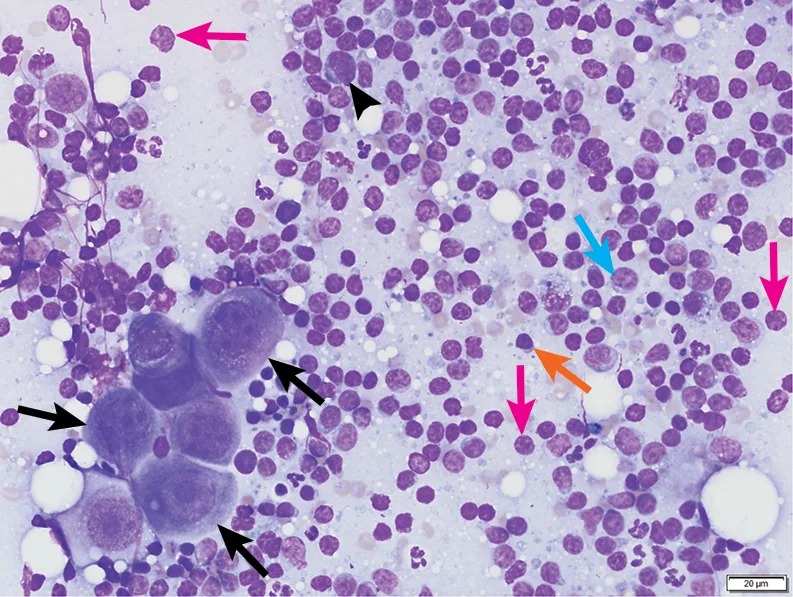 Clinical Image: Lymph Node Aspirate