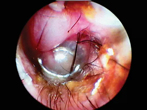 Otoscopic image of domed eardrum with hair and yellow exudate visible in internal ear canal.