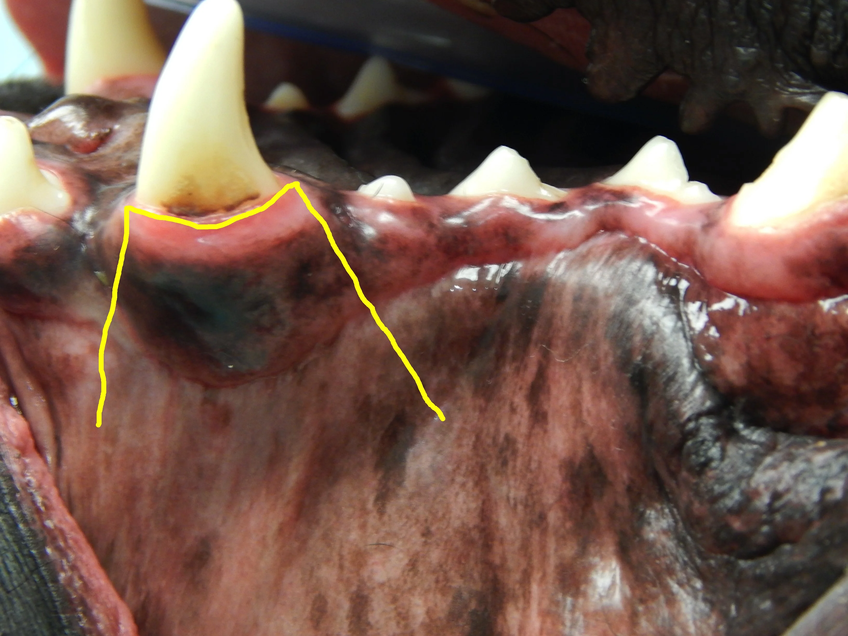 A maxillary canine tooth showing two potential releasing incisions to create a mucogingival flap. 