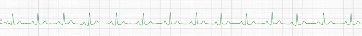 ECG tracing of a normal sinus rhythm.