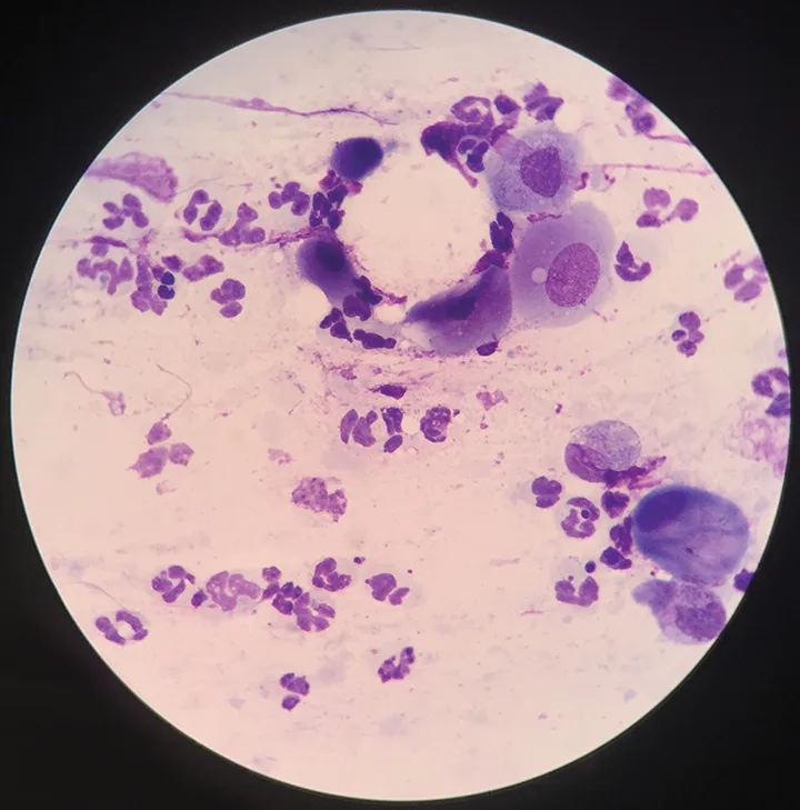 Conjunctival cytology slide showing seveal round nucleated cells and moderate number of smaller neutrophils.