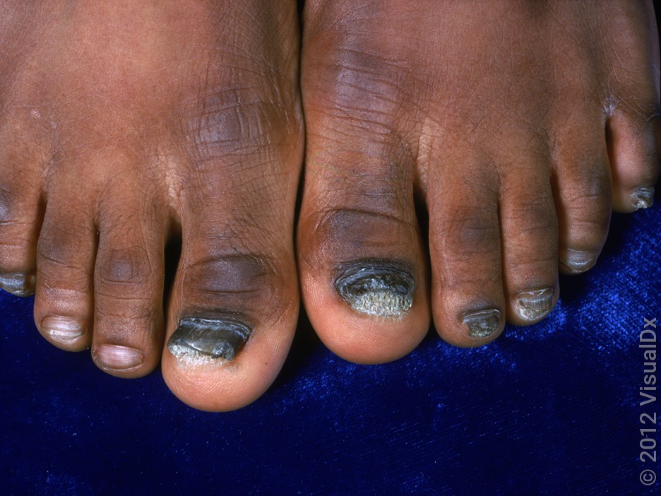 Close-up of ringworm on the toenails (onychomycosis).