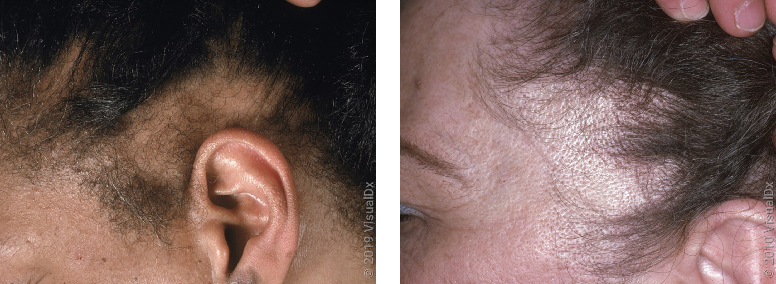 Left: Close-up of the side of the scalp with patchy hair loss in traction alopecia. Right: Close-up of a temple with a band of hair loss in traction alopecia.