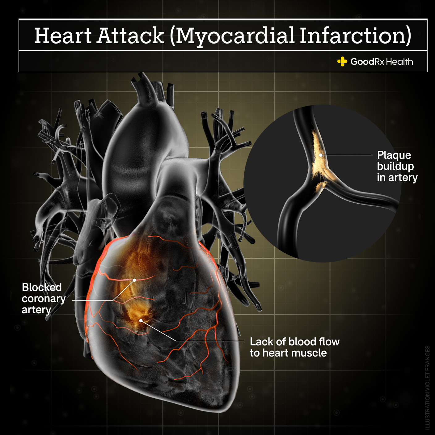 A 3D illustration of a heart attack including plaque buildup in artery, blocked coronary artery, and lack of blood flow to heart muscle.