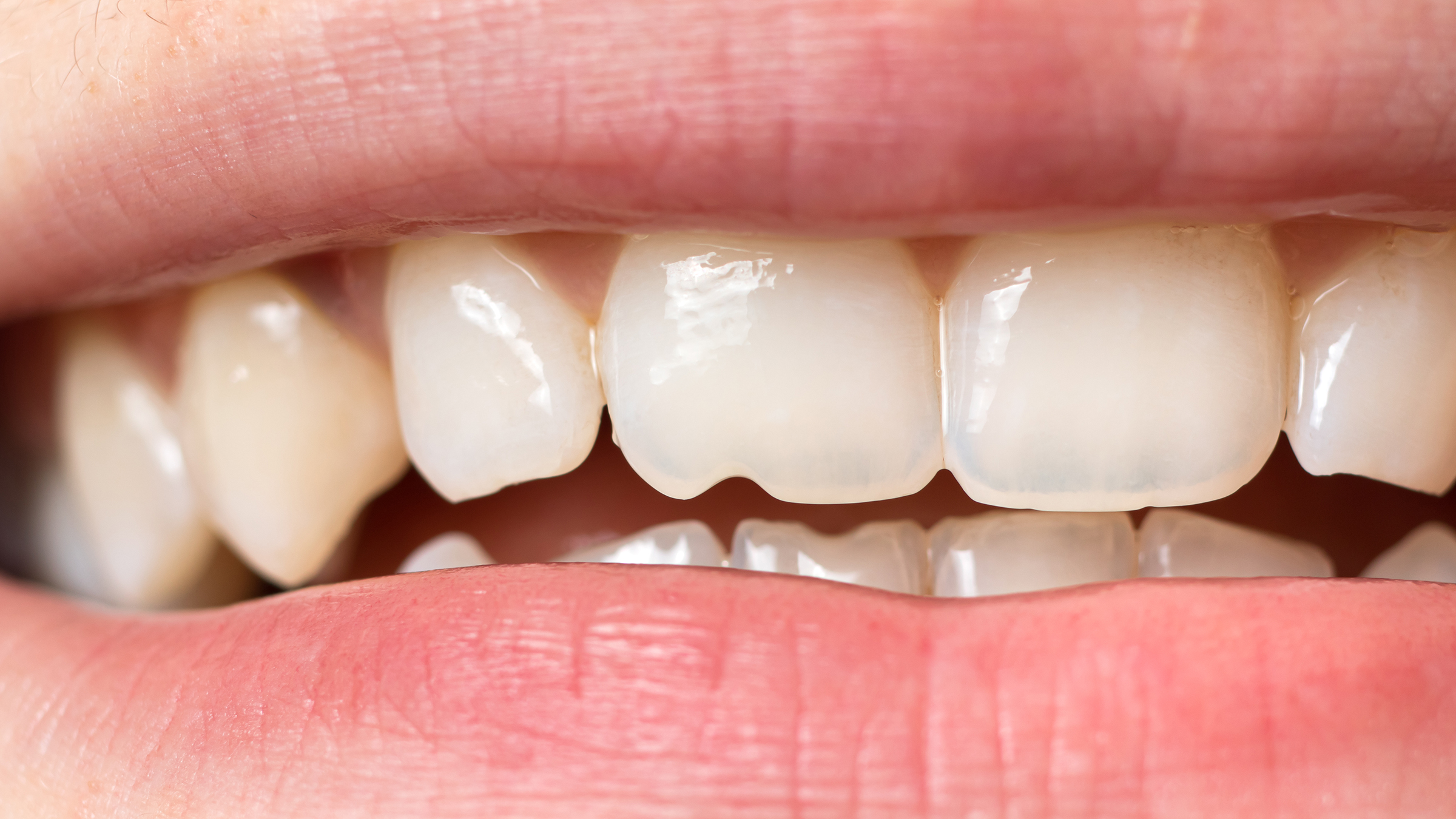 Почему появляется шершавость на зубах с внутренней стороны