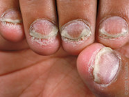 Psoriatic Arthritis Fingernails What Are The First Signs Of Psoriatic Psoriatic Arthritis Fingernails What Are The First Signs Of Psoriatic