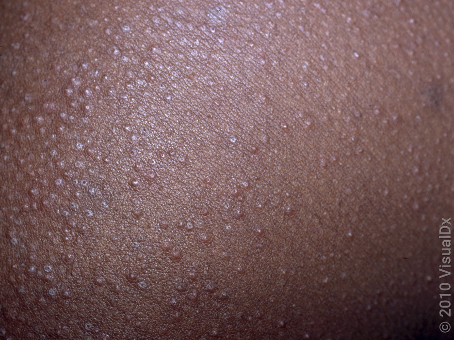 Close-up of fungal acne (pityrosporum folliculitis).